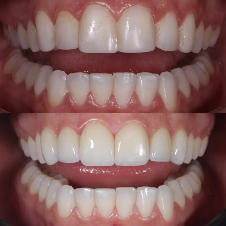 Sorriso antes e depois do clareamento dental