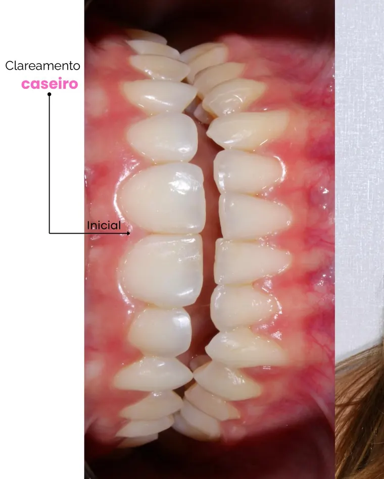 Dentes antes e depois do clareamento caseiro