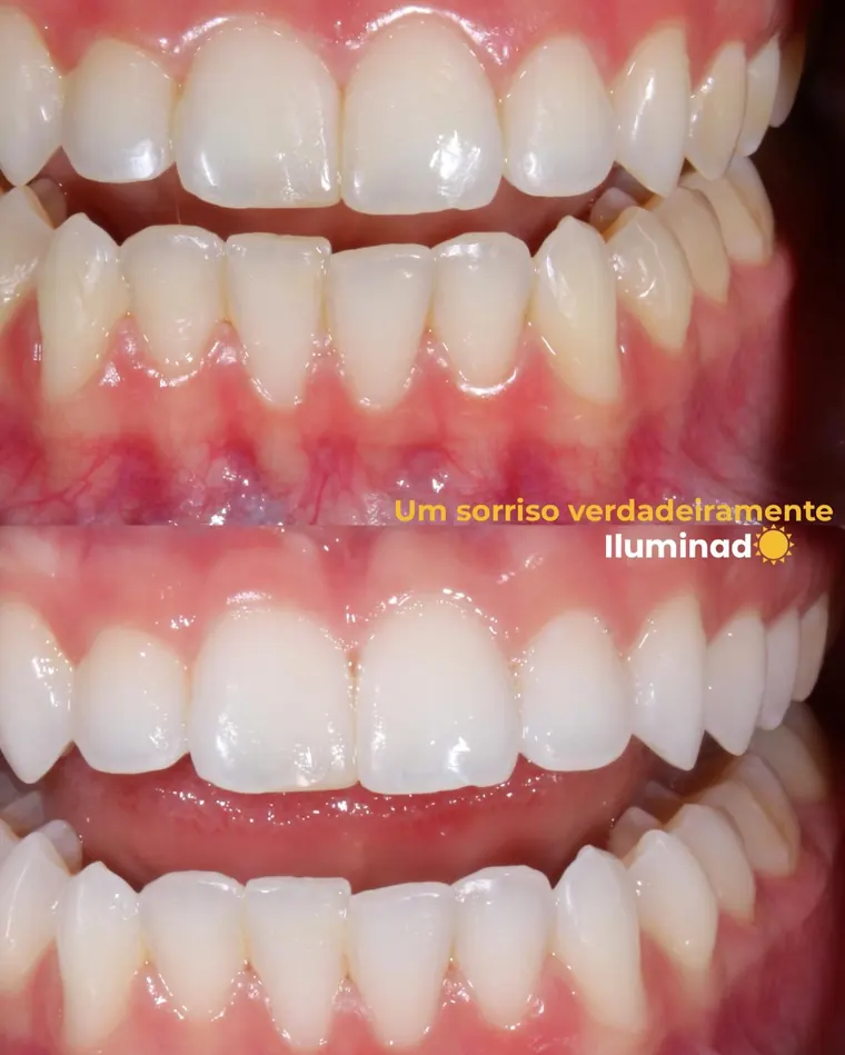 Arcadas antes e depois do clareamento