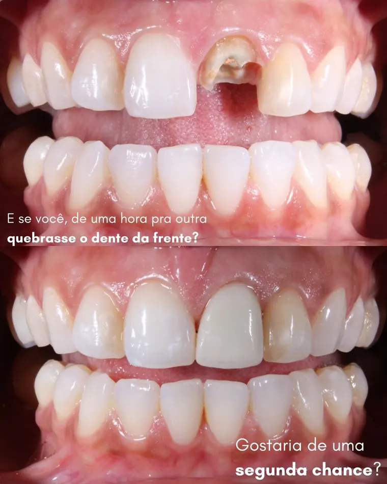 Dente da frente fraturado antes e depois da coroa em cerâmica