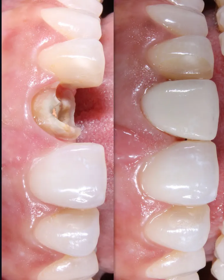 Dente anterior destruído antes e depois da reconstrução