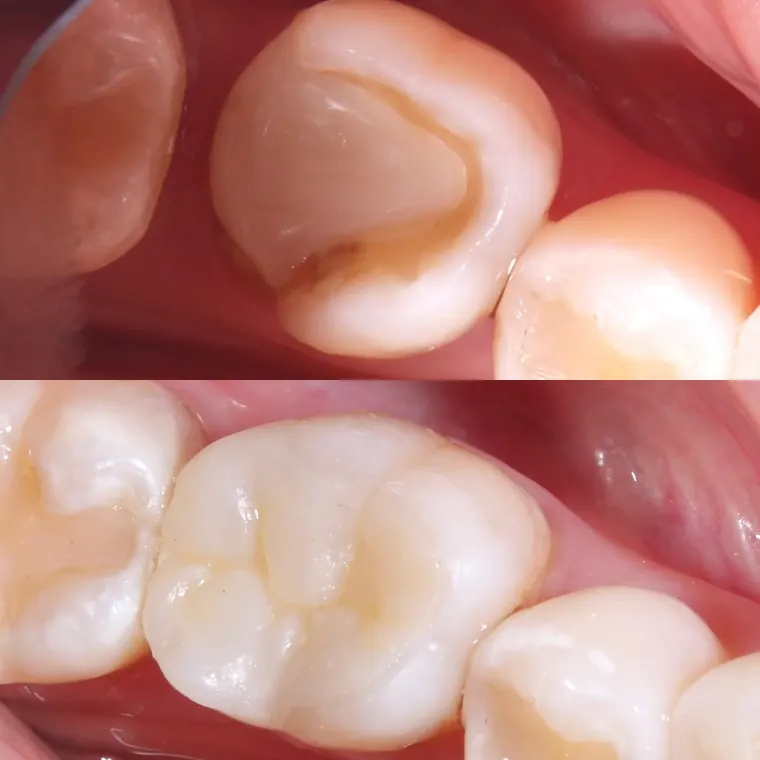 Molar antes e depois de restauração estética