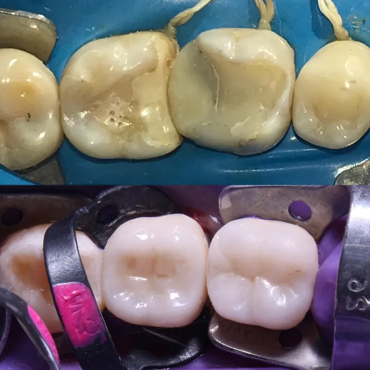 Dentes posteriores antes e depois de restaurações