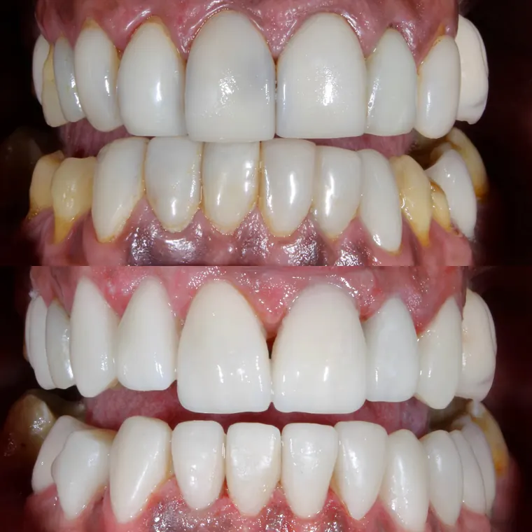 Arcadas antes e depois de reabilitação estética dos dentes da frente