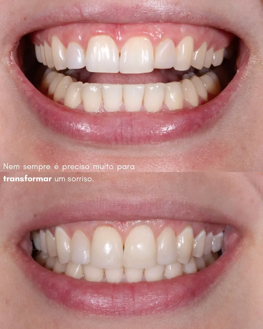 Sorriso antes e depois de correção com resina composta