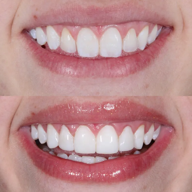Dentes da frente antes e depois de ajuste de forma e cor em resina