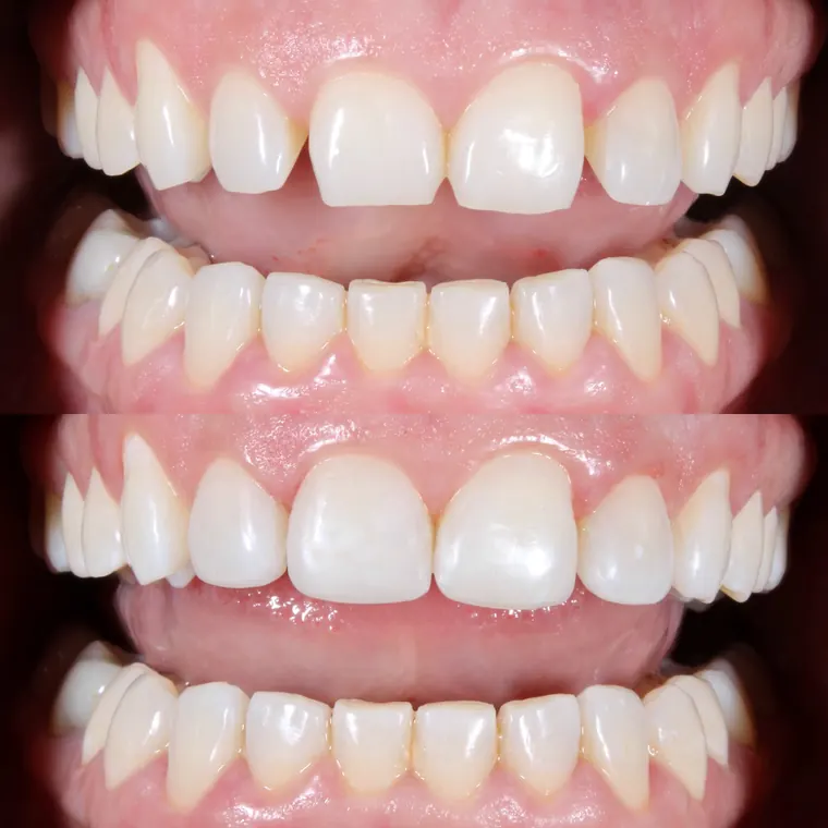 Arcadas antes e depois de harmonização dos dentes com resina
