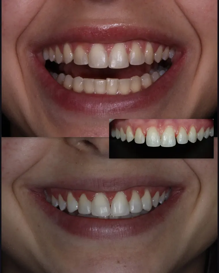 Sorriso antes e depois de ajuste do contorno dos dentes