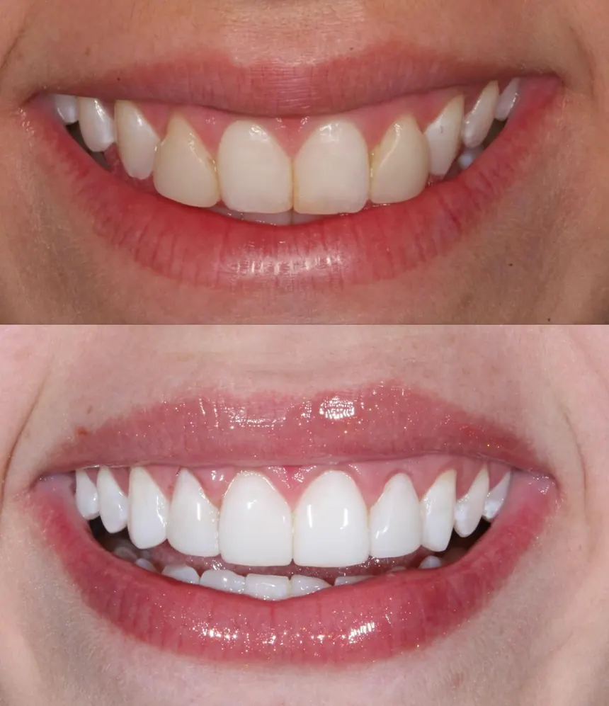 Sorriso antes e depois do ajuste do contorno da gengiva